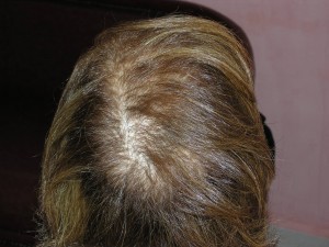 Comment effectuer une greffe de cheveux pour femme ?