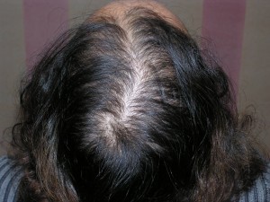 greffe de cheveux FUT pour femme